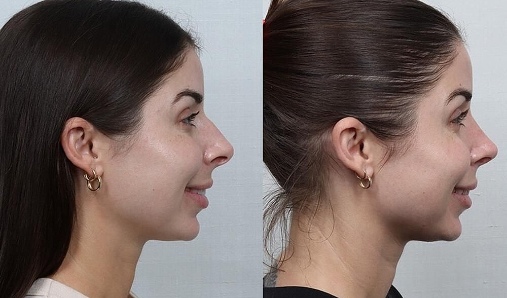 Rhinoplasty Before & After