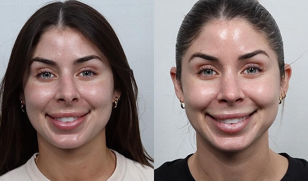 Rhinoplasty Before & After