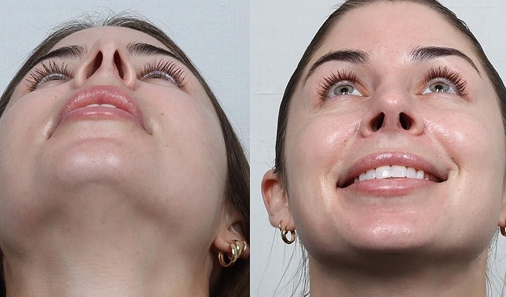 Rhinoplasty Before & After