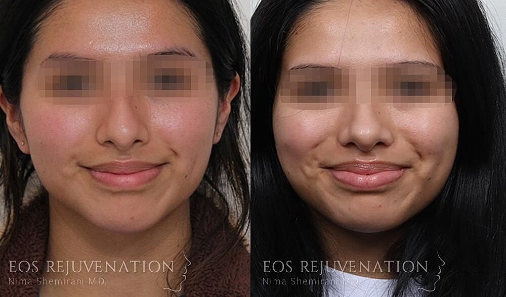 Rhinoplasty Before & After