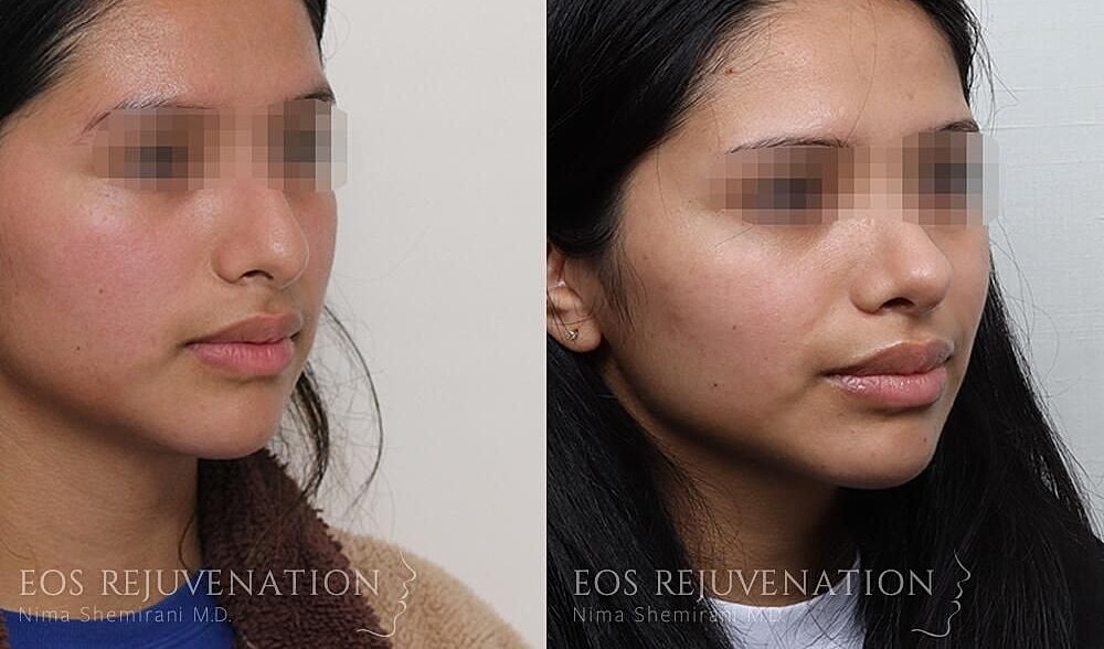 Rhinoplasty Before & After