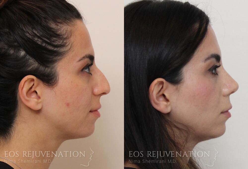 Rhinoplasty Before & After