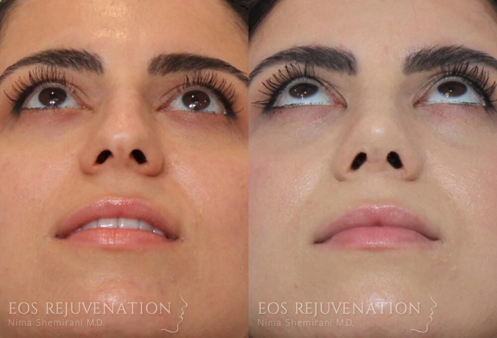 Rhinoplasty Before & After