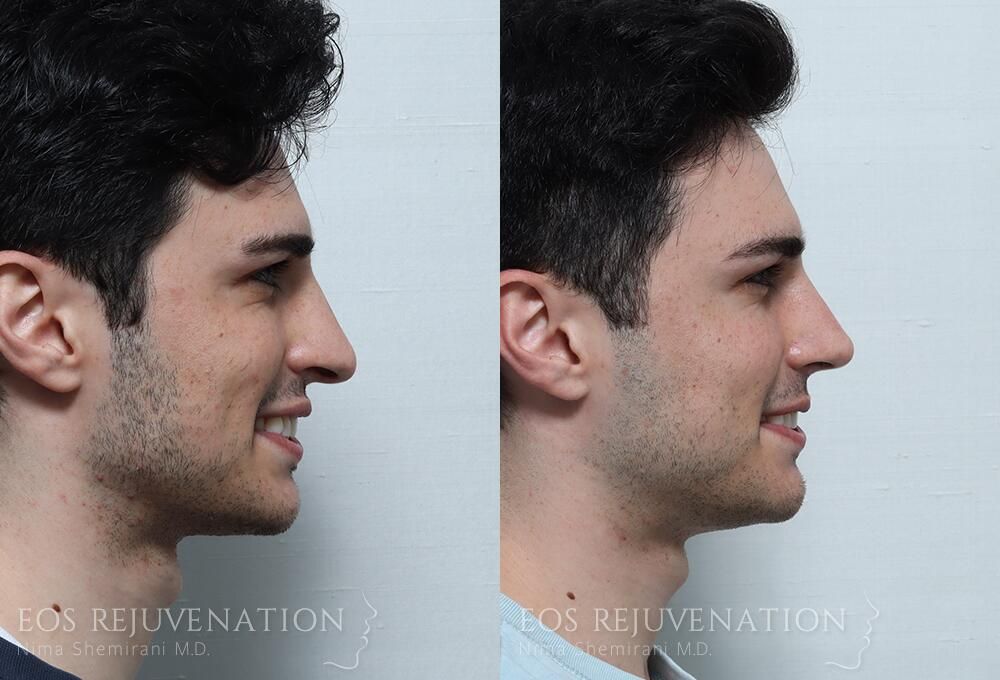 Rhinoplasty Before & After