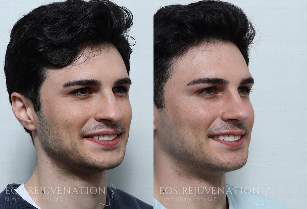 Rhinoplasty Before & After