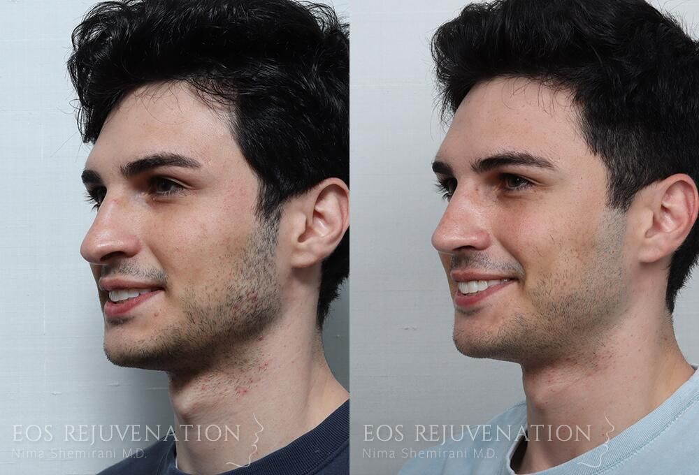 Rhinoplasty Before & After