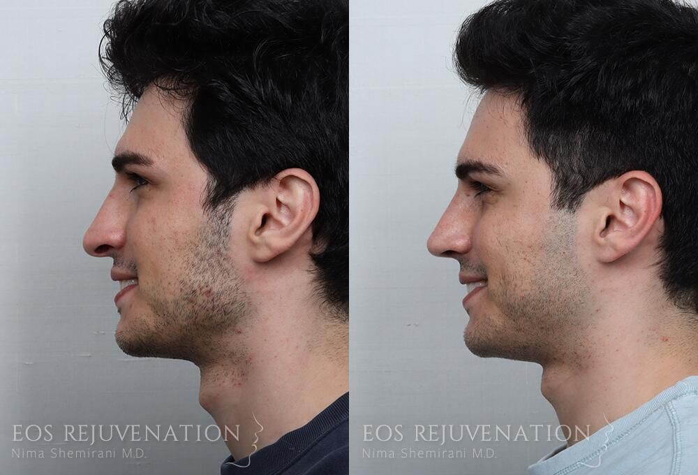 Rhinoplasty Before & After
