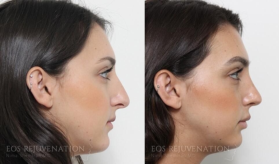 Rhinoplasty Before & After