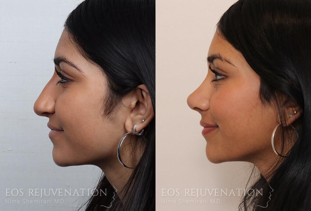 Rhinoplasty Before & After