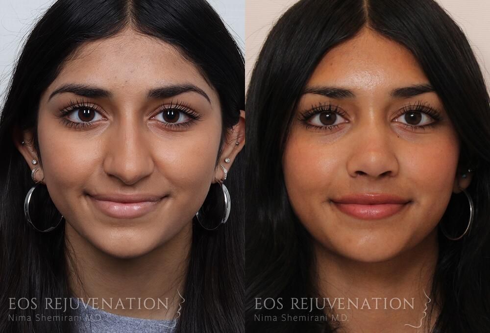 Rhinoplasty Before & After