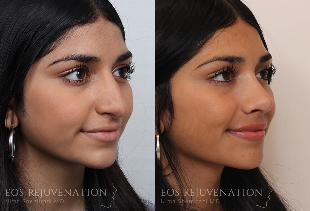 Rhinoplasty Before & After