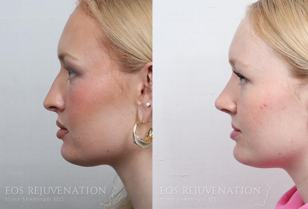 Rhinoplasty Before & After