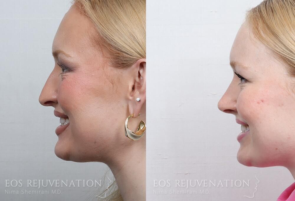 Rhinoplasty Before & After
