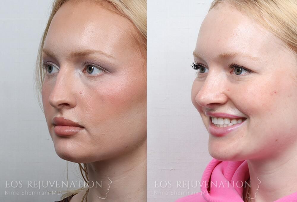 Rhinoplasty Before & After