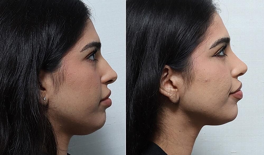 Rhinoplasty Before & After