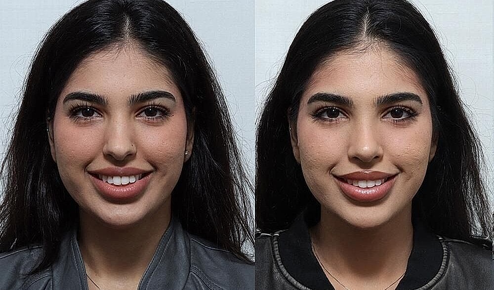 Rhinoplasty Before & After