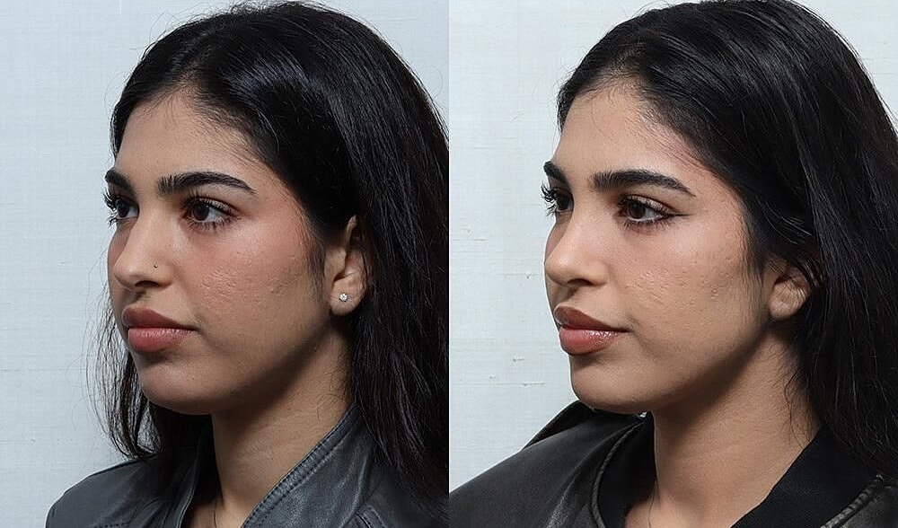Rhinoplasty Before & After