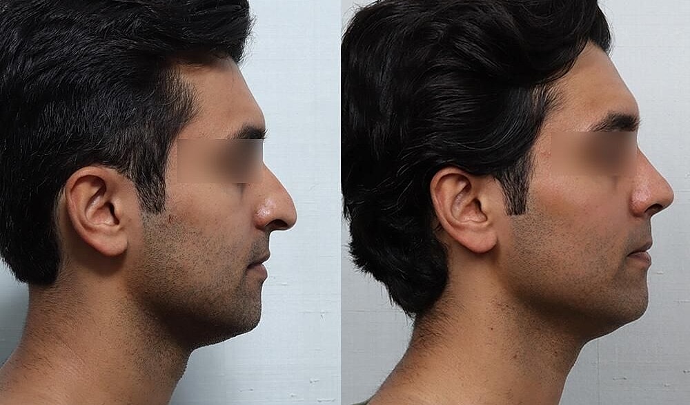Rhinoplasty Before & After