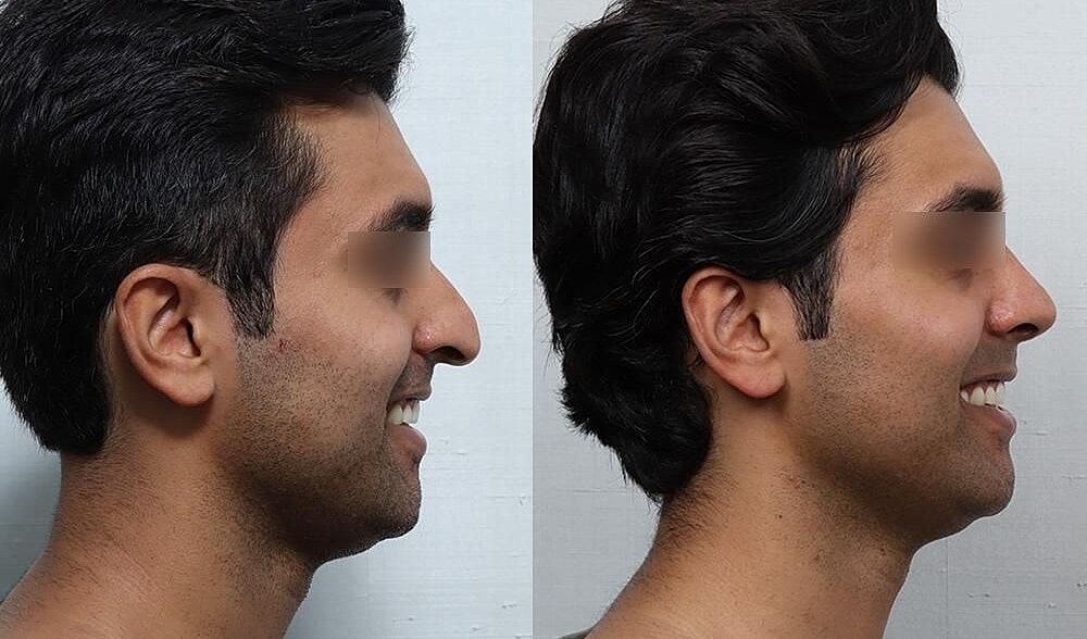 Rhinoplasty Before & After