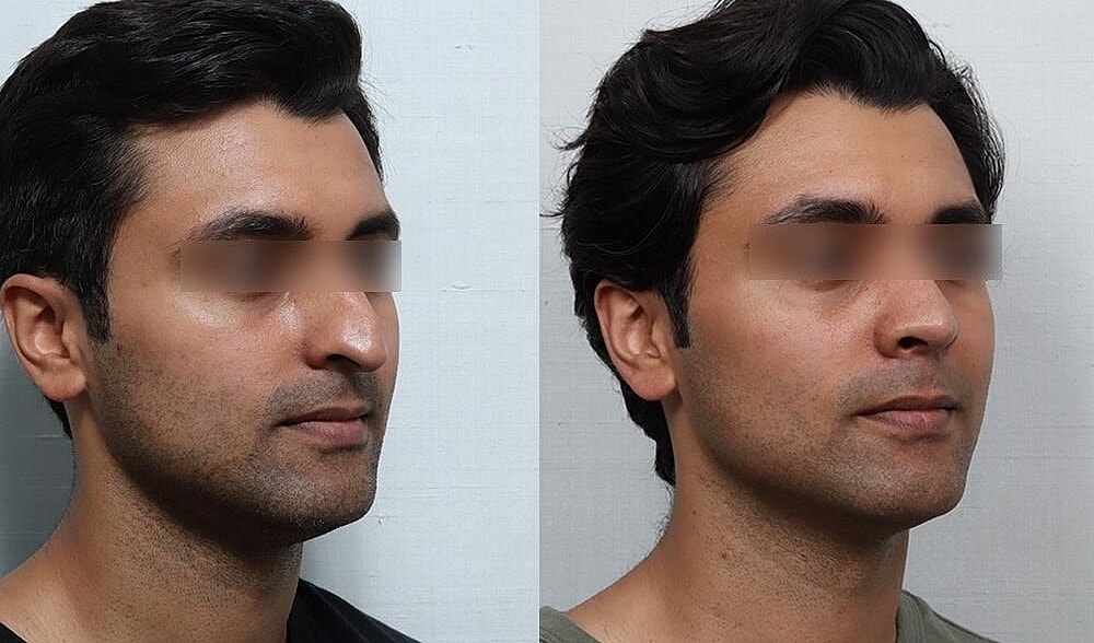 Rhinoplasty Before & After