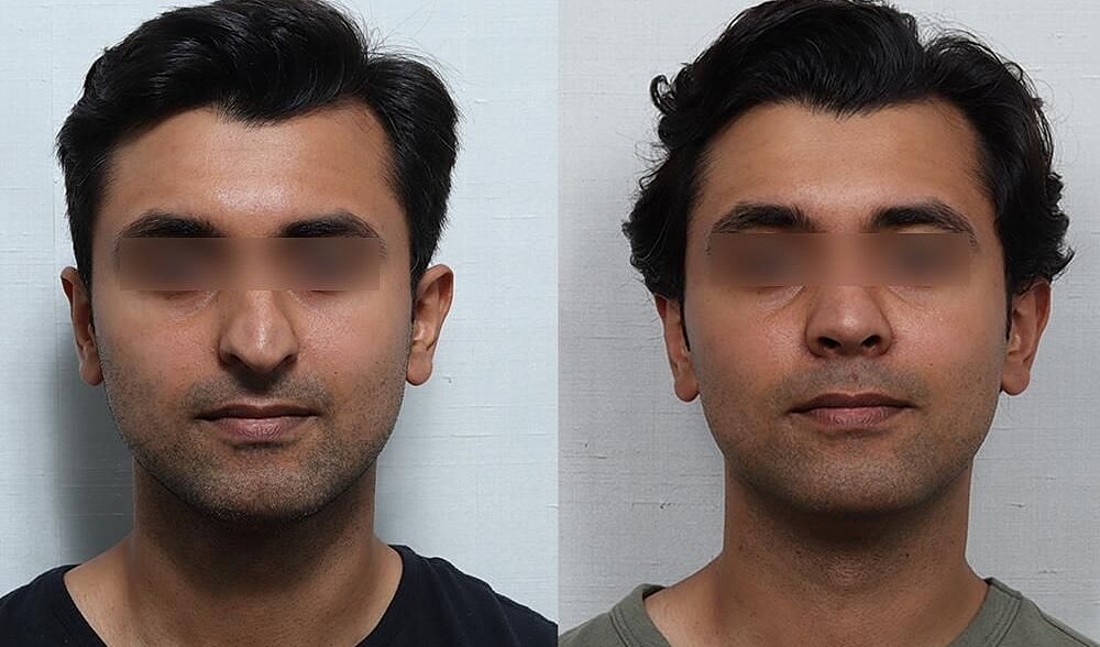Rhinoplasty Before & After