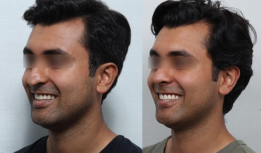 Rhinoplasty Before & After
