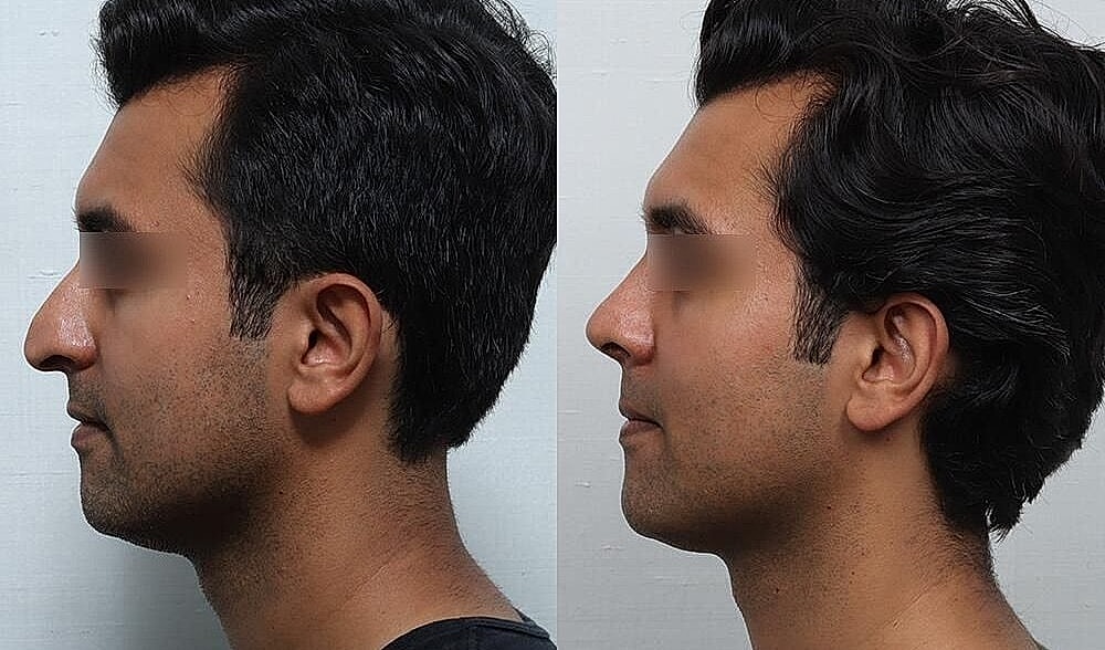 Rhinoplasty Before & After
