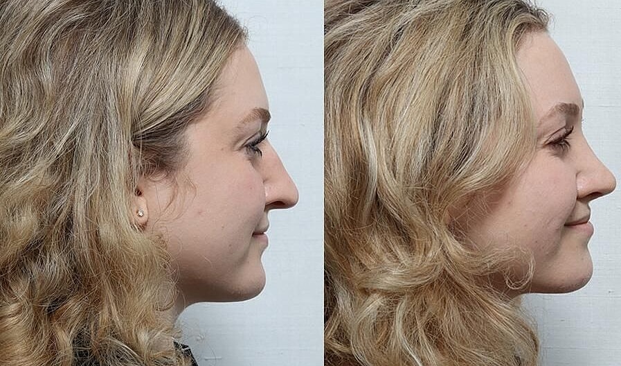 Rhinoplasty Before & After