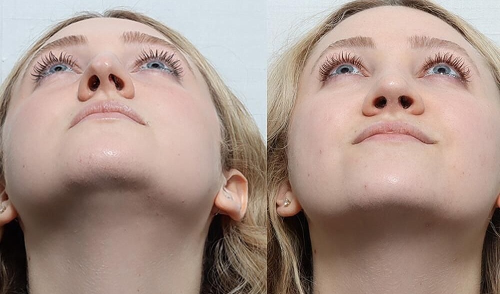 Rhinoplasty Before & After
