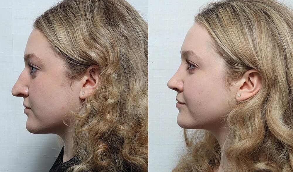 Rhinoplasty Before & After