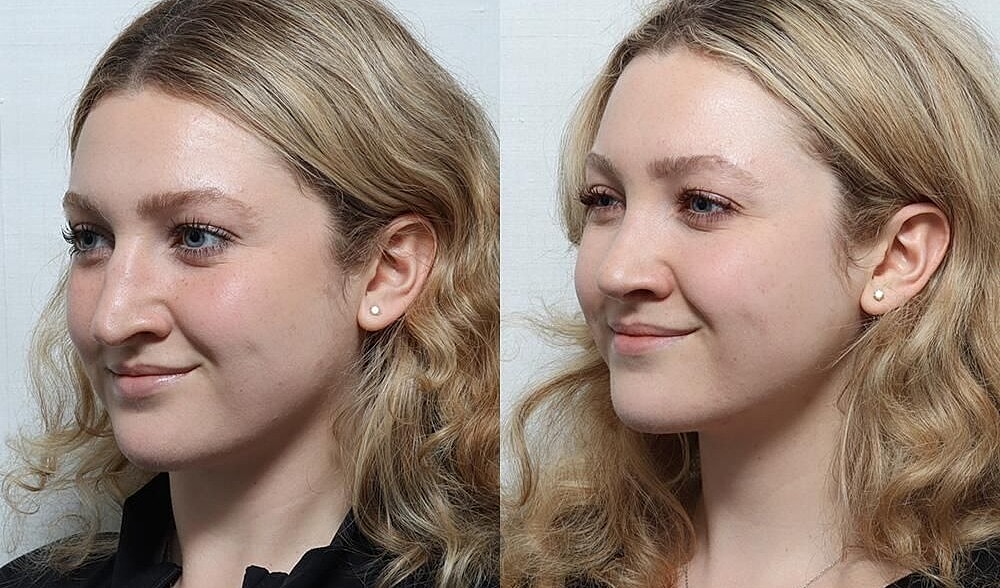 Rhinoplasty Before & After
