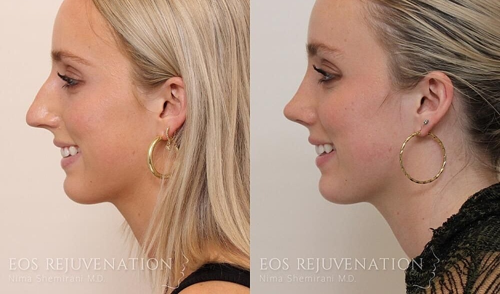 Rhinoplasty Before & After