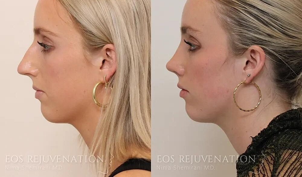 Rhinoplasty Before & After