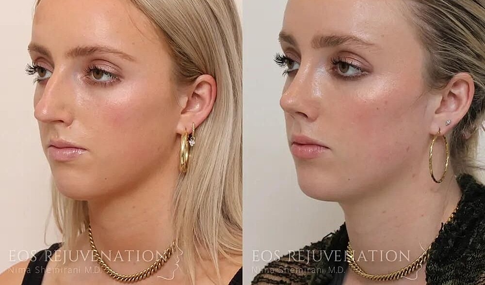 Rhinoplasty Before & After