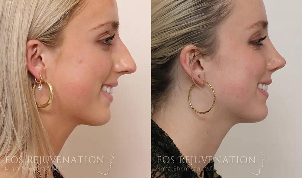 Rhinoplasty Before & After