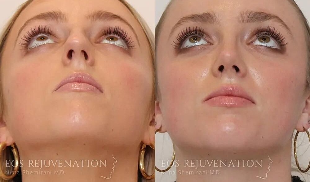 Rhinoplasty Before & After