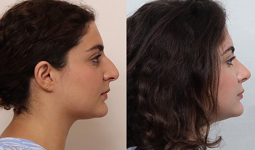 Rhinoplasty Before & After