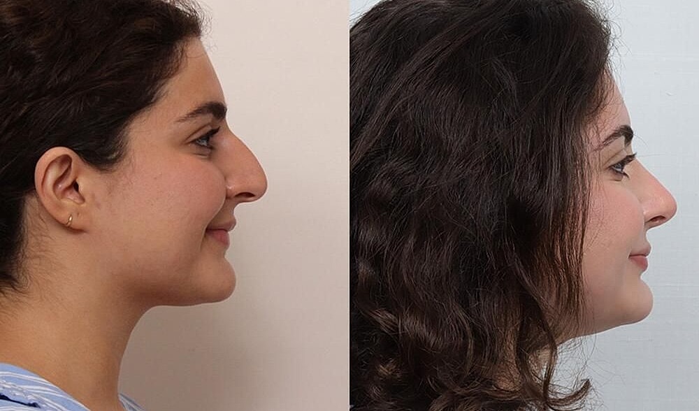 Rhinoplasty Before & After