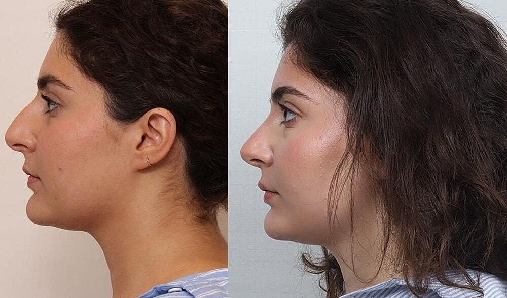 Rhinoplasty Before & After