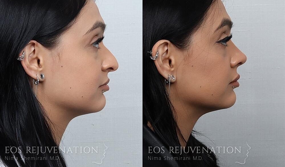 Rhinoplasty Before & After