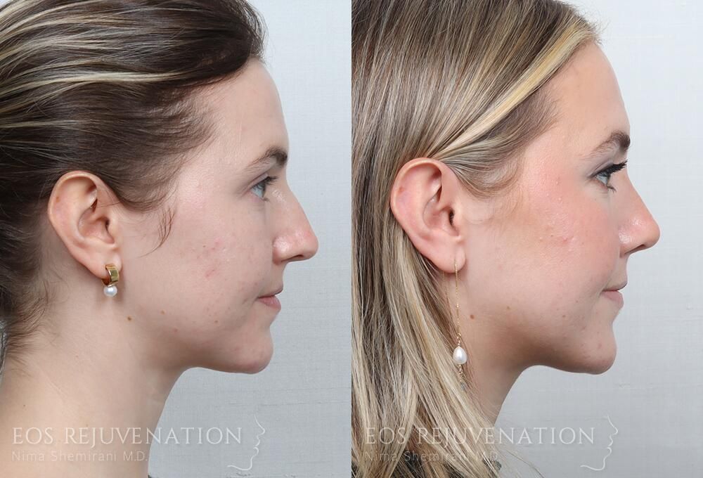 Rhinoplasty Before & After