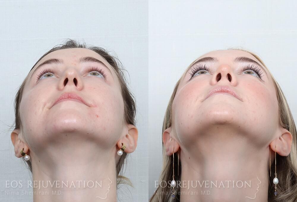 Rhinoplasty Before & After