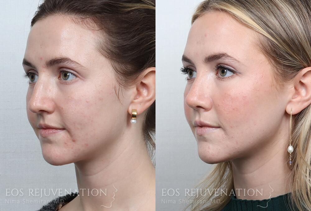 Rhinoplasty Before & After