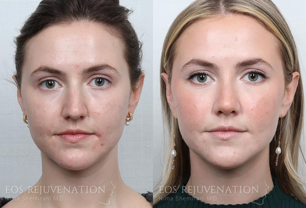 Rhinoplasty Before & After