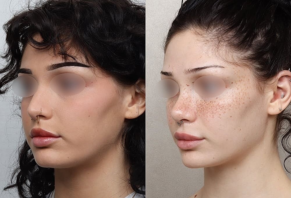 Before and after makeover comparison with freckles.