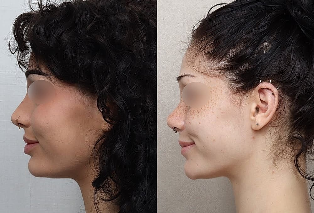 Before and after profile comparison of women.