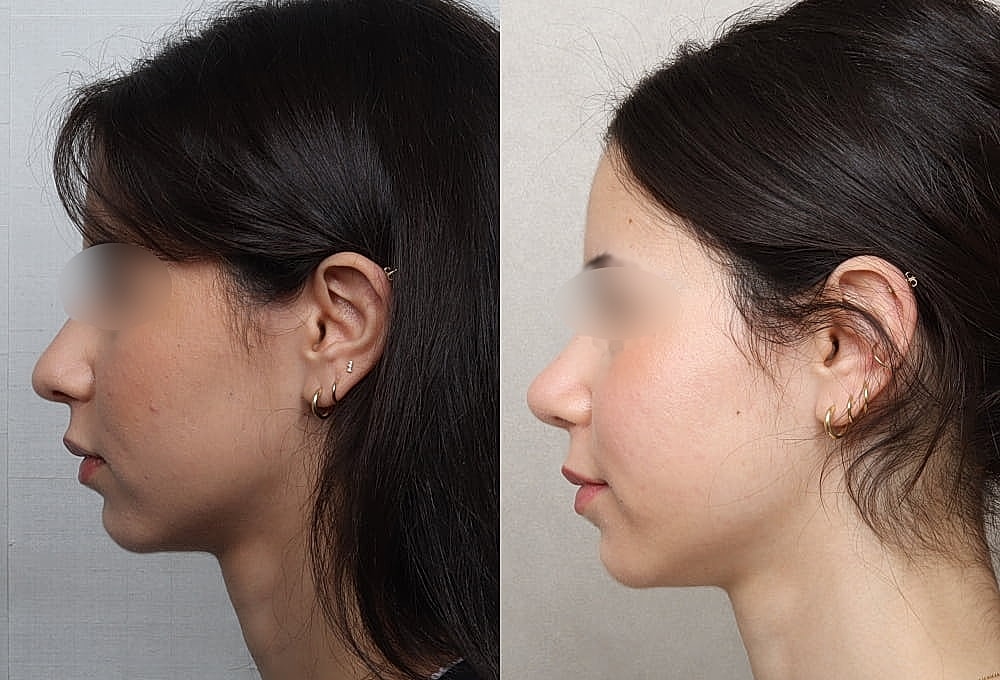Side profile comparison of a woman.