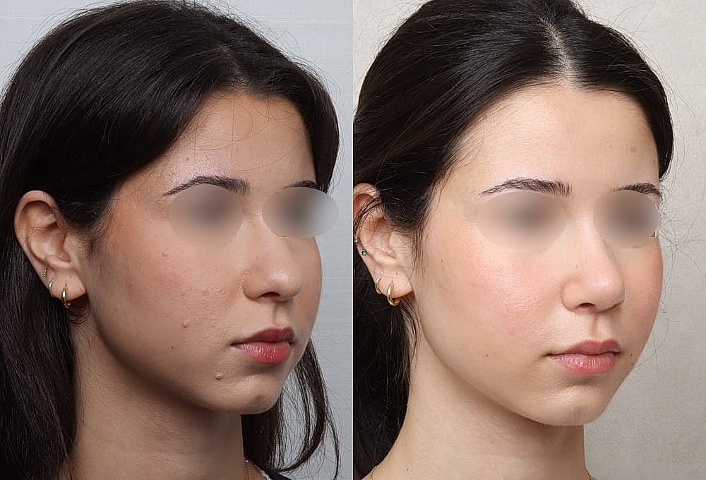 Before and after facial treatment comparison.