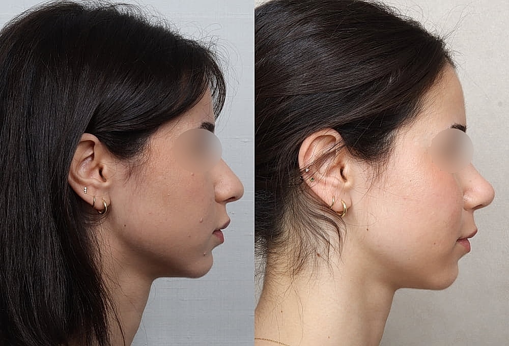 Side profile comparison of two hairstyles.