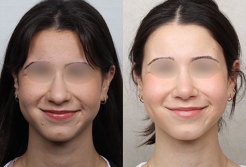 Before and after facial transformation comparison.